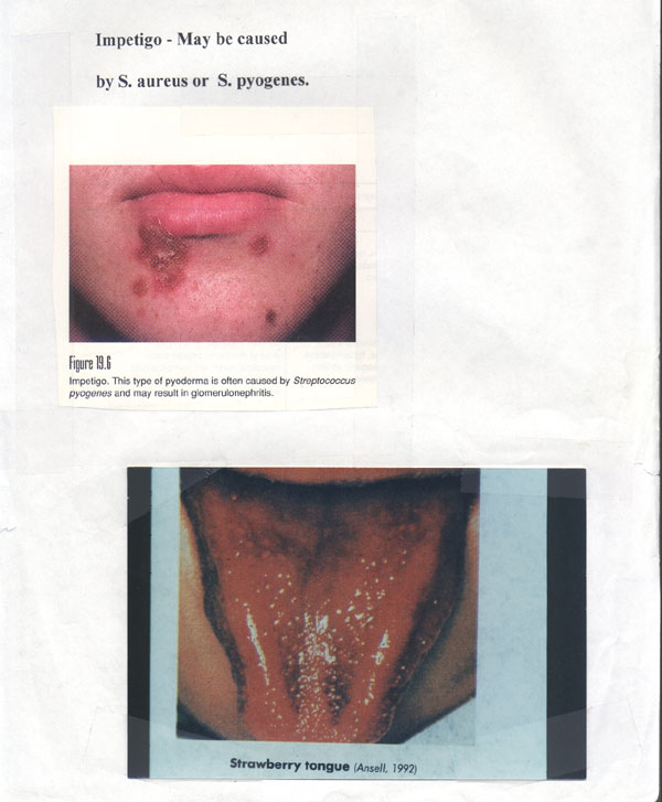 impetigo1.jpg
