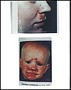 impetigo2.jpg